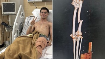 Moto3: Frattura scomposta al femore per David Munoz: è stato operato in Indonesia