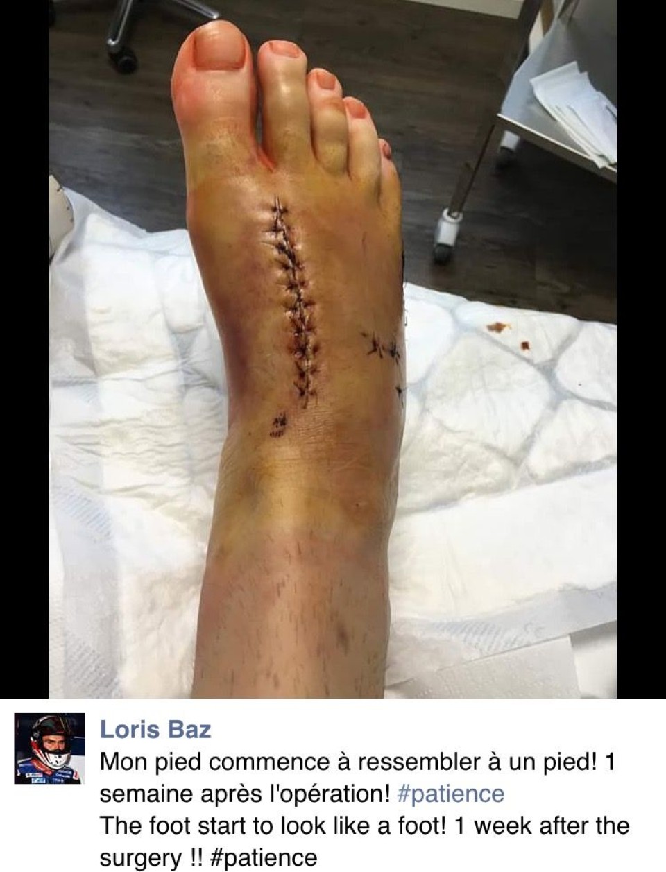 Loris Baz: ora il mio piede sembra il mio piede