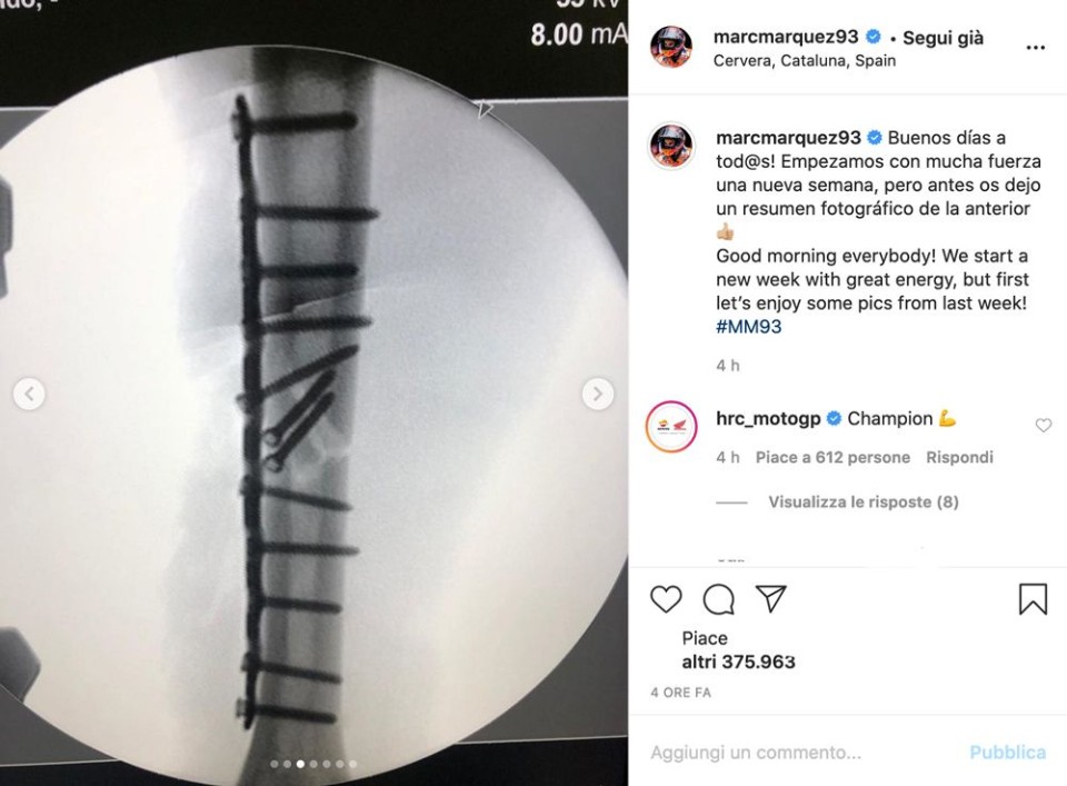 MotoGP: Marc Marquez shows the evidence: here are the photo of his fracture