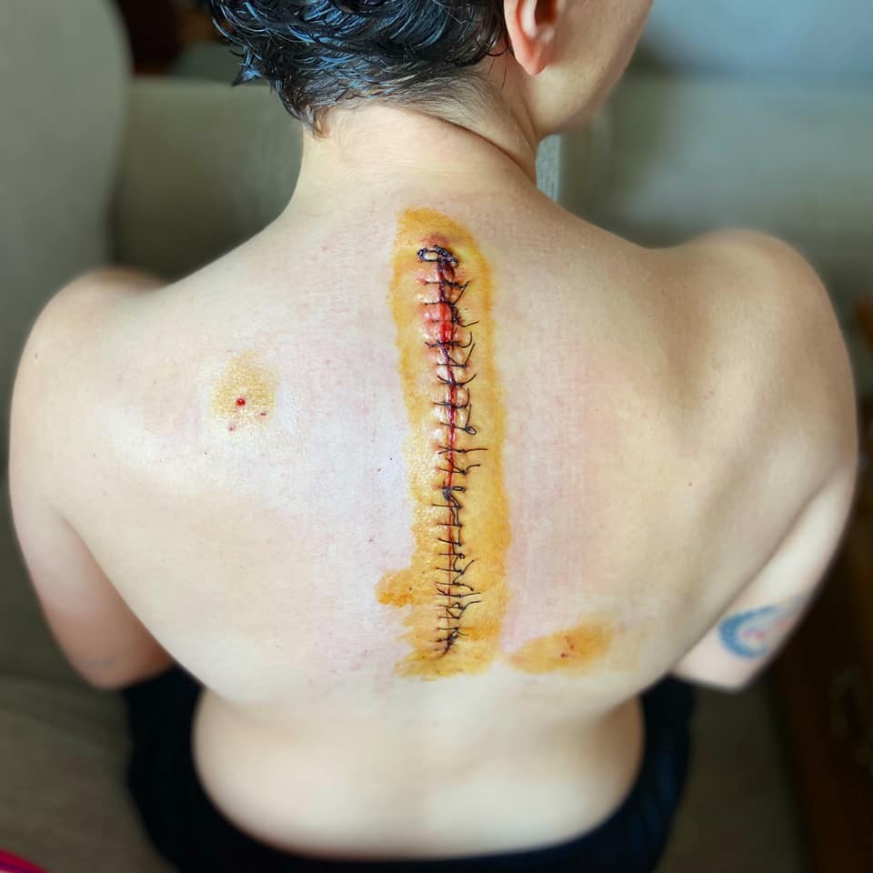 SBK: Ana Carrasco unstoppable: her back after plates were removed 