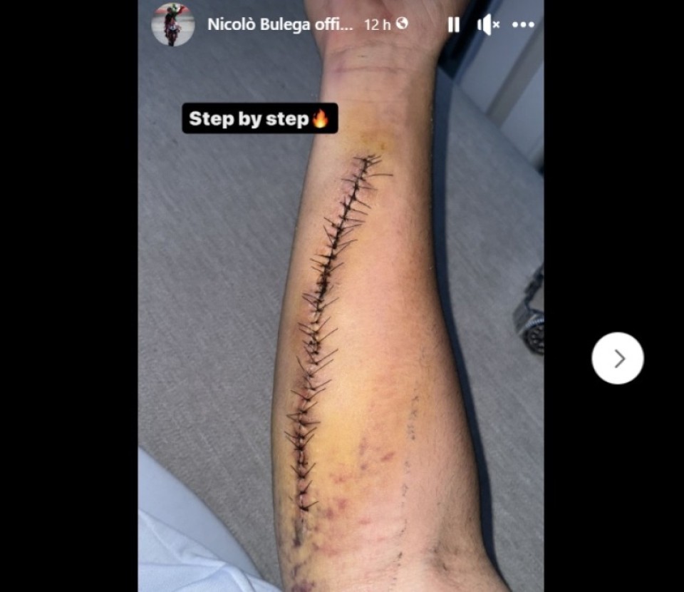 SBK: Ecco il braccio di Bulega con oltre 30 punti di sutura
