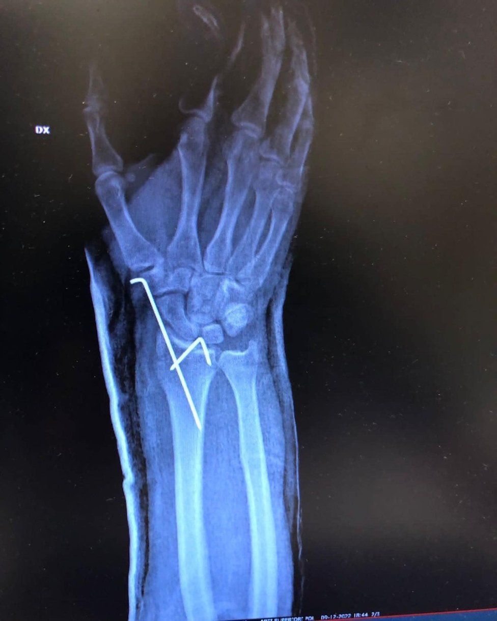 MotoGP: Dovizioso fa il botto nel motocross: frattura scomposta del polso destro