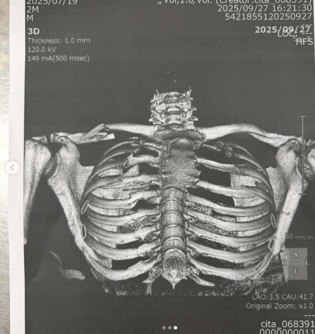MotoGP: Ecco come si presenta la frattura scomposta della clavicola di Jorge Martin