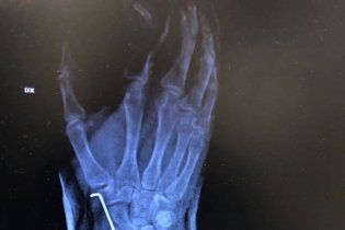 MotoGP: Dovizioso fa il botto nel motocross: frattura scomposta del polso destro