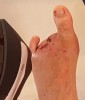 SBK: Niki Tuuli’s foot after toe amputation